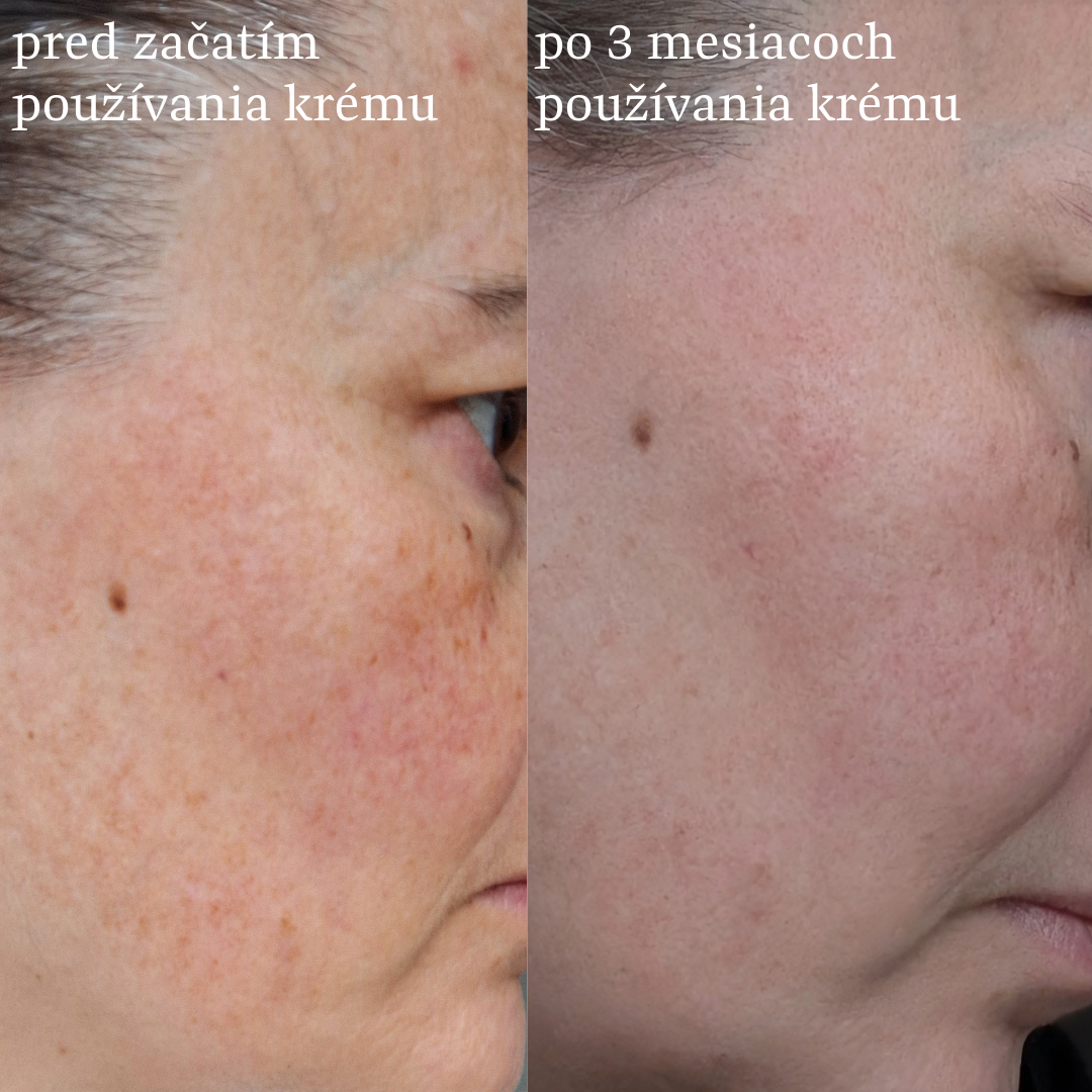 Detail pleti s pigmentovými škvrnami pred a po začatí používania hydratačného krému Théa